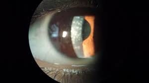 التهاب قرنية العين