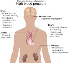 ارتفاع ضغط الدم