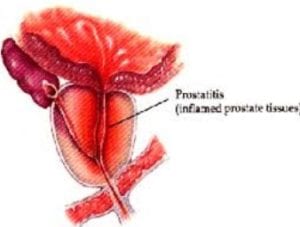 inflamare prostata