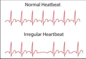 عدم إنتظام ضربات القلب