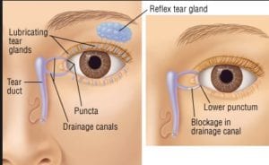 انسداد مجرى الدمع