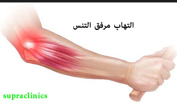 التهاب عصب التنس
