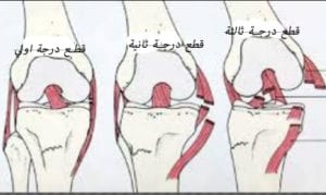 اصابة الرباط الصليبي