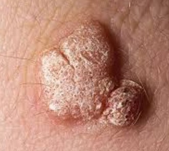 كيف ينتقل فيروس hpv