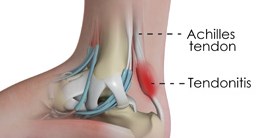 علاج التهاب وتر اكيلس