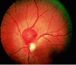علاج ورم شبكية العين