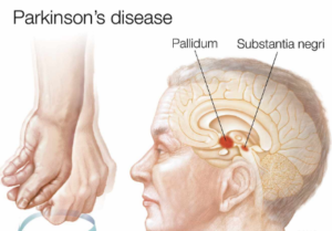 مراحل تطور مرض باركنسون