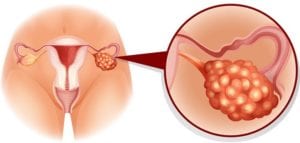 اسباب تكيسات المبايض