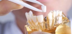 هل زراعة الاسنان مؤلمة