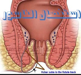 استئصال الناسور