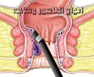 انواع الناسور وعلاجه