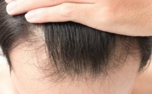 علاج تساقط الشعر عند الرجال من الامام