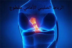 الرباط الصليبي الامامي للركبة