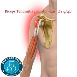 التهاب وتر عضلة البايسبس Biceps Tendinitis