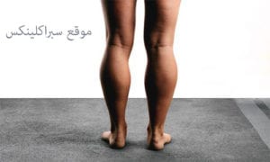 عضلة سمانة الساق