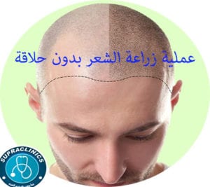 عملية زراعة الشعر بدون حلاقة