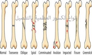 انواع الكسور العظمية بالتفصيل