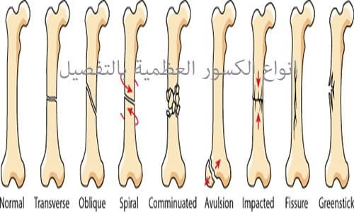 انواع الكسور العظمية بالتفصيل