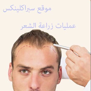 عمليات زراعة الشعر