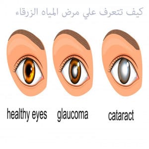 مرض المياه الزرقاء في العين