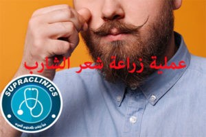 عملية زراعة شعر الشارب